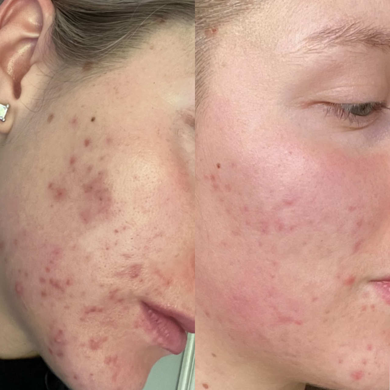 Acne scarring improvement