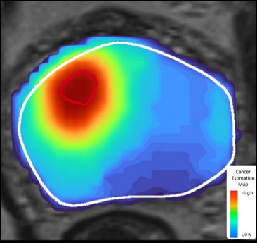 Unfold AI | Avenda Health | Precision Prostate Cancer Treatment