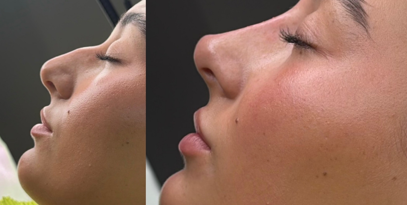Non-Surgical Rhinoplasty