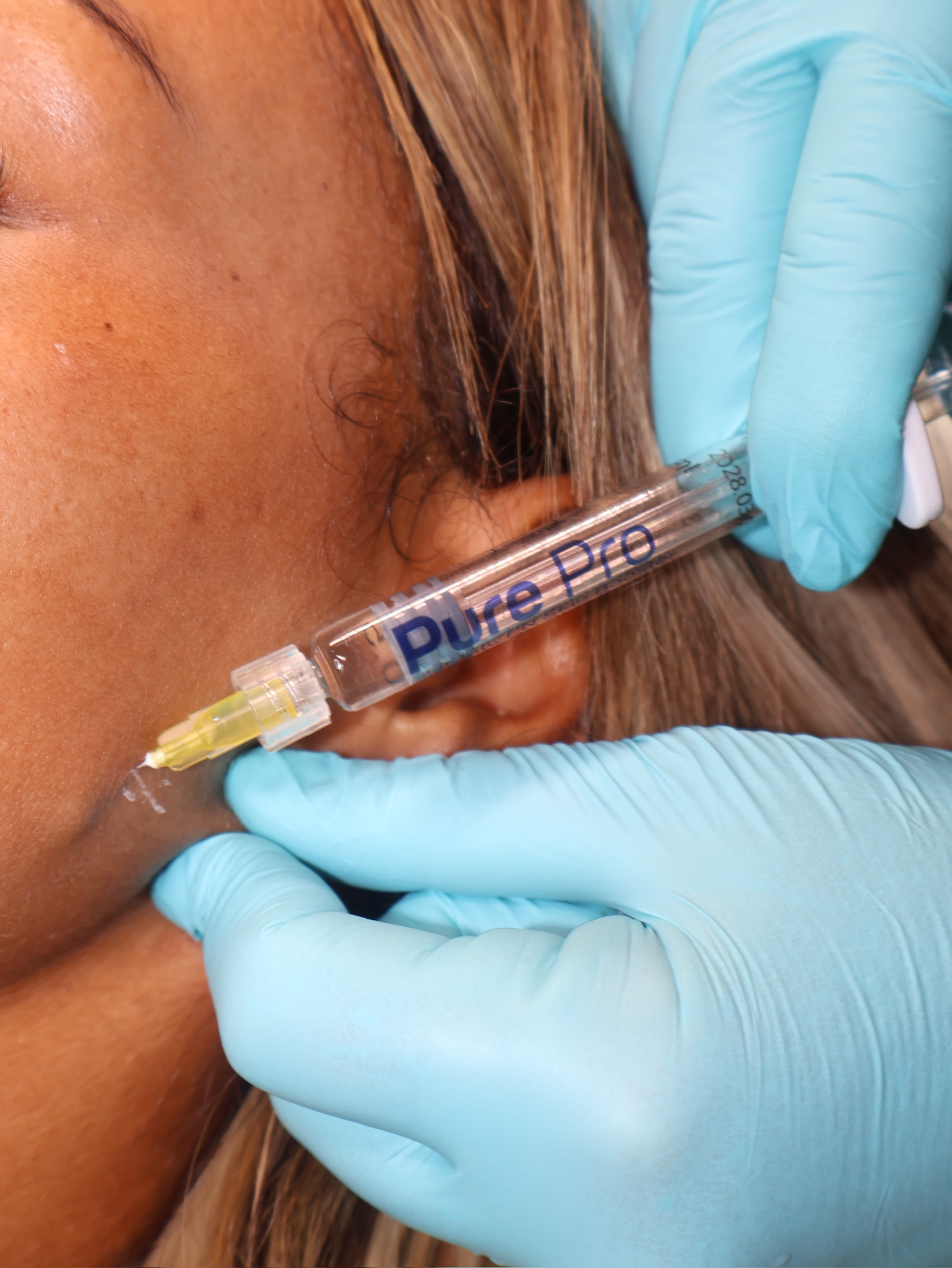 Skin Boosters/Hyaluronic Acid & Polynucleotides