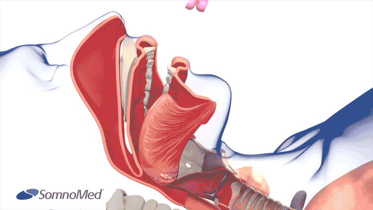 Oral Appliance Therapy Illustration