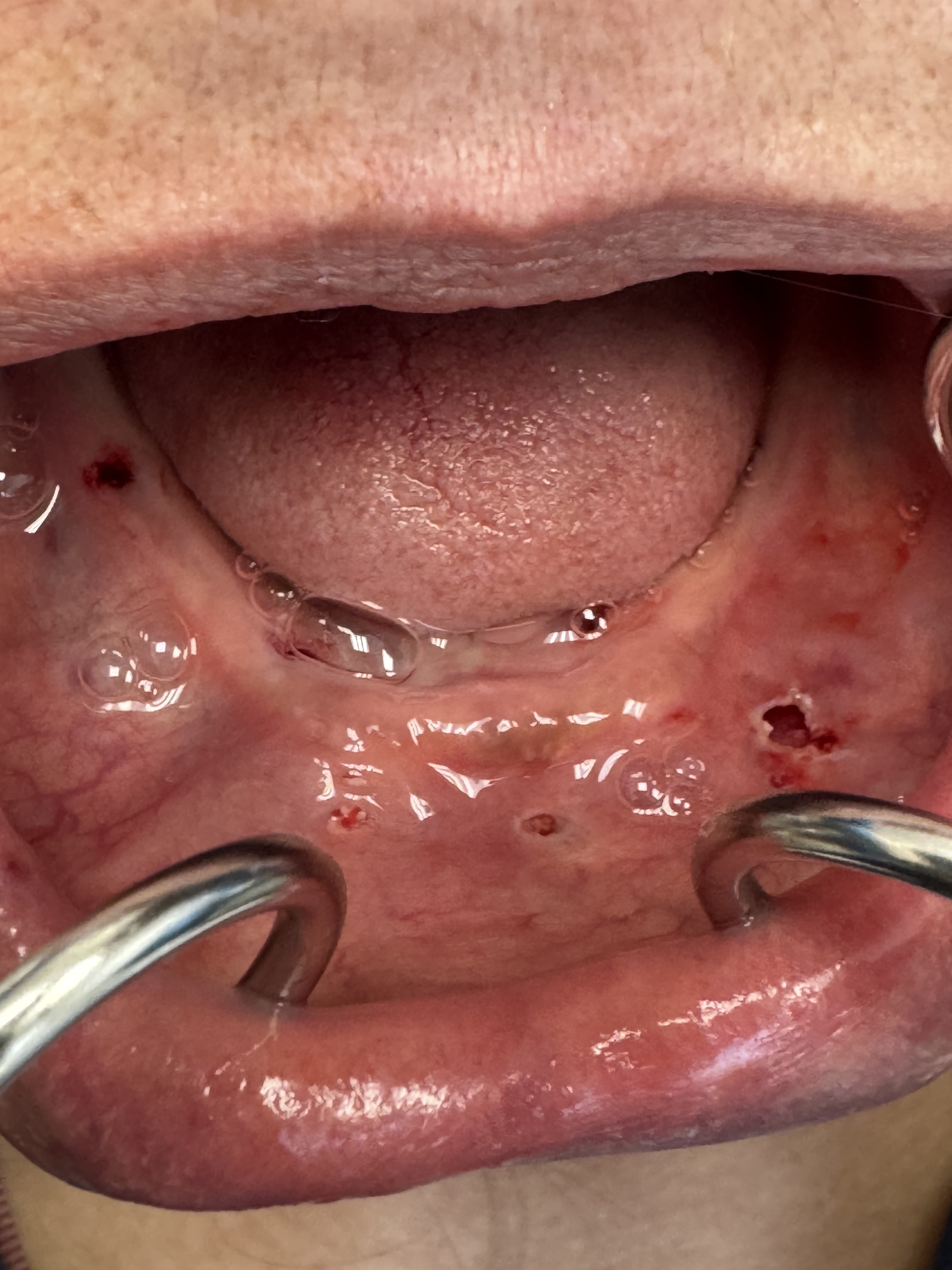 Robotic surgery case 1