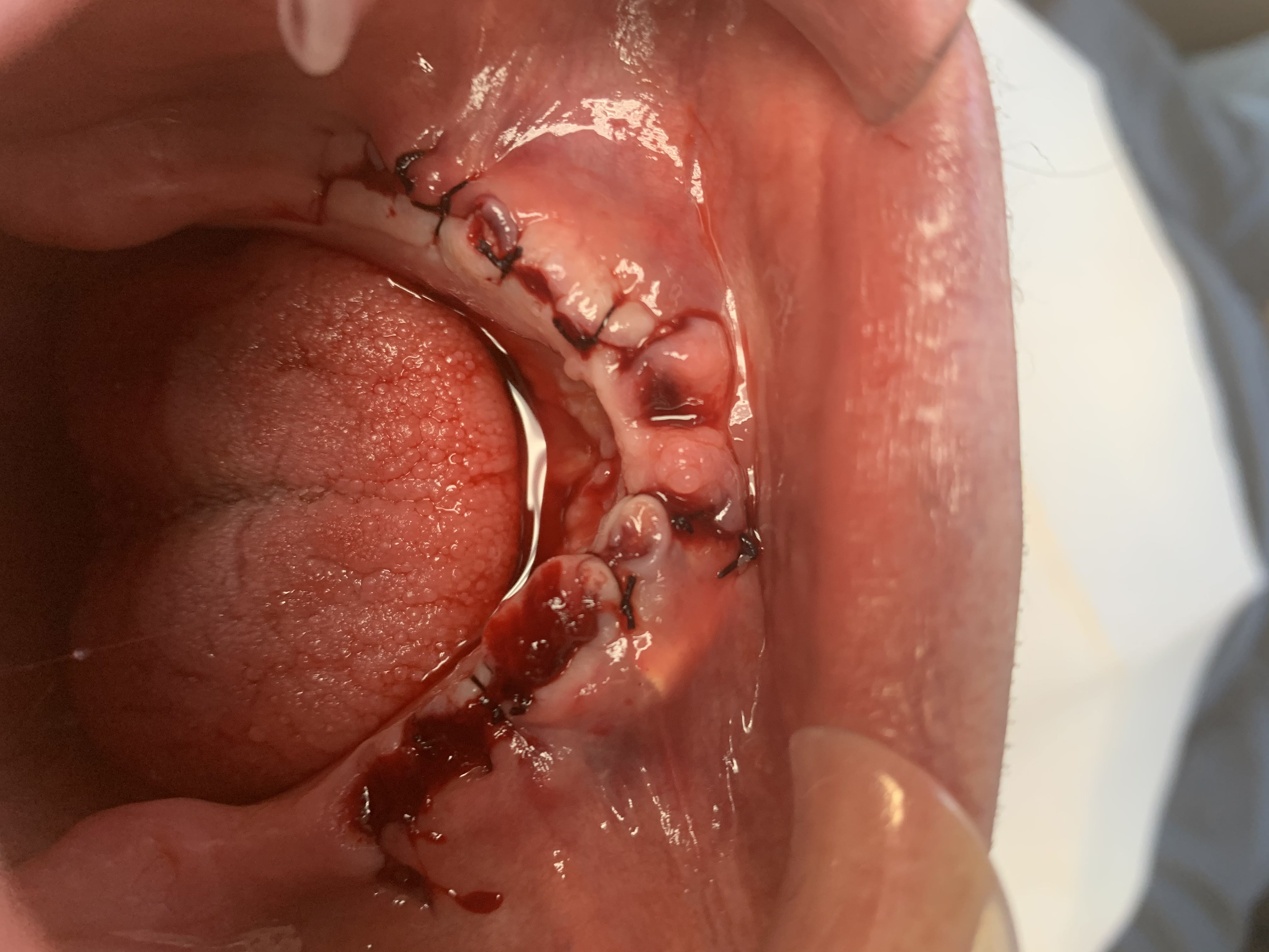 Traditional surgery case 1