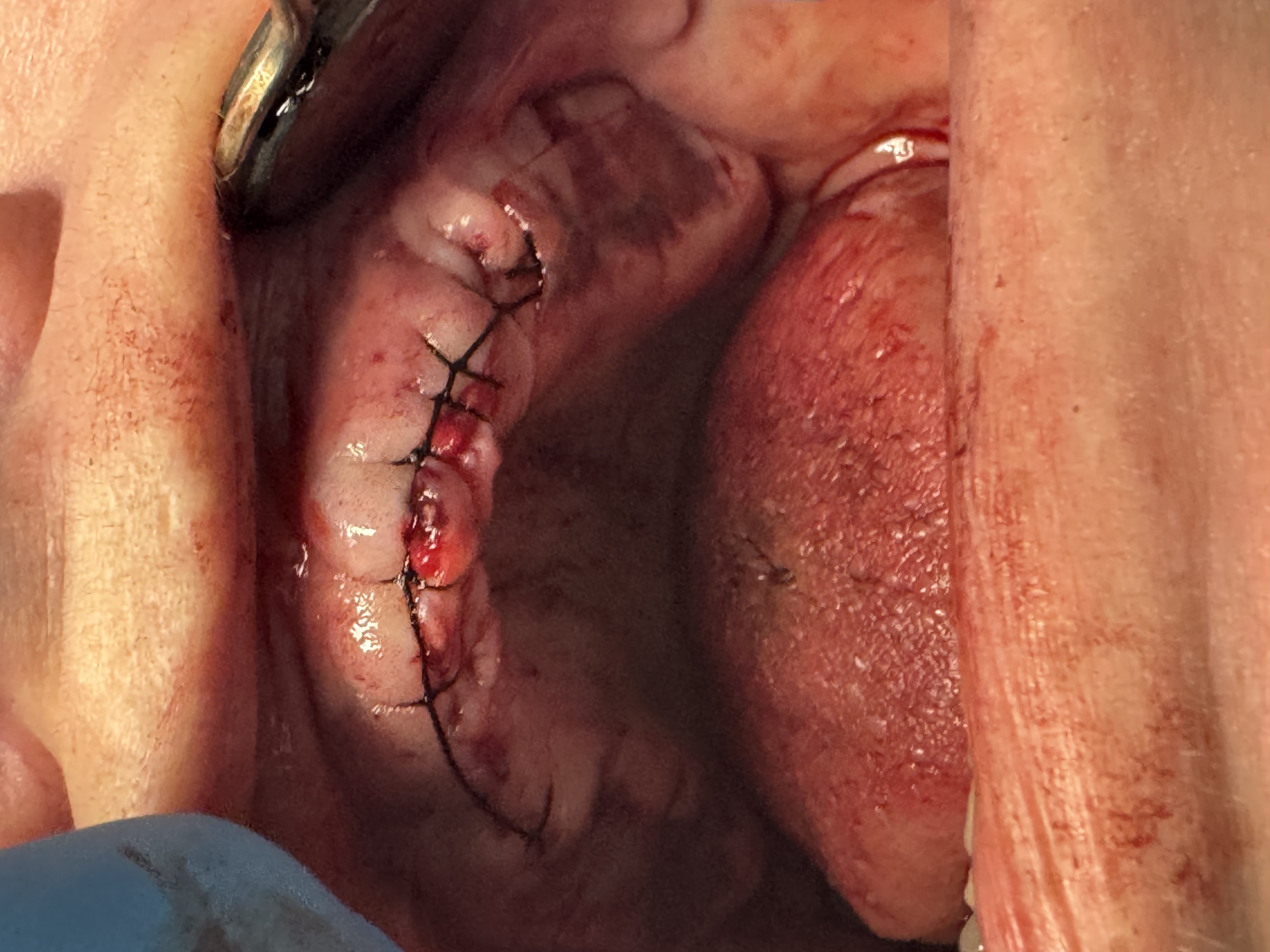 Traditional surgery case 2