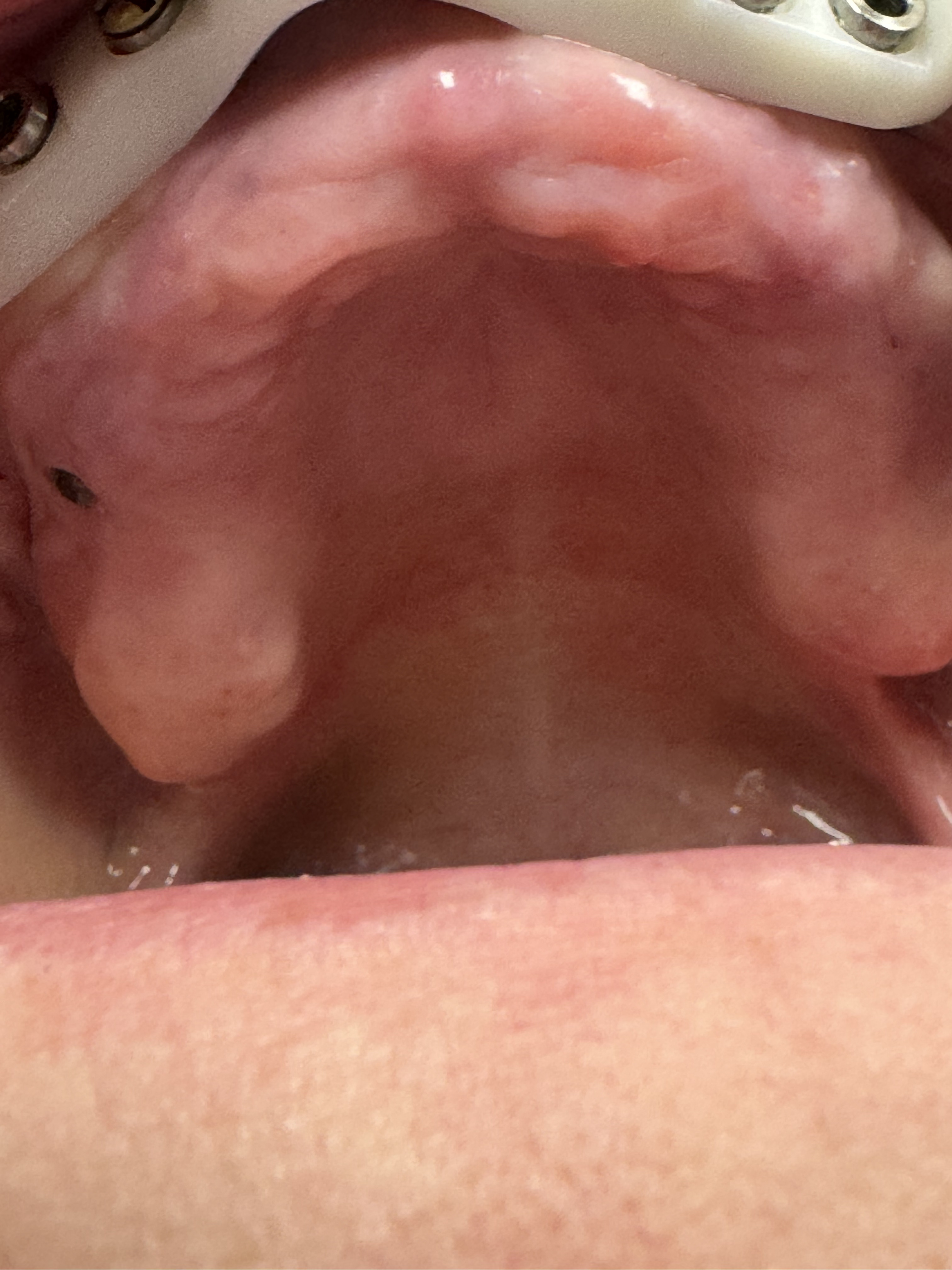 Robotic case before 1