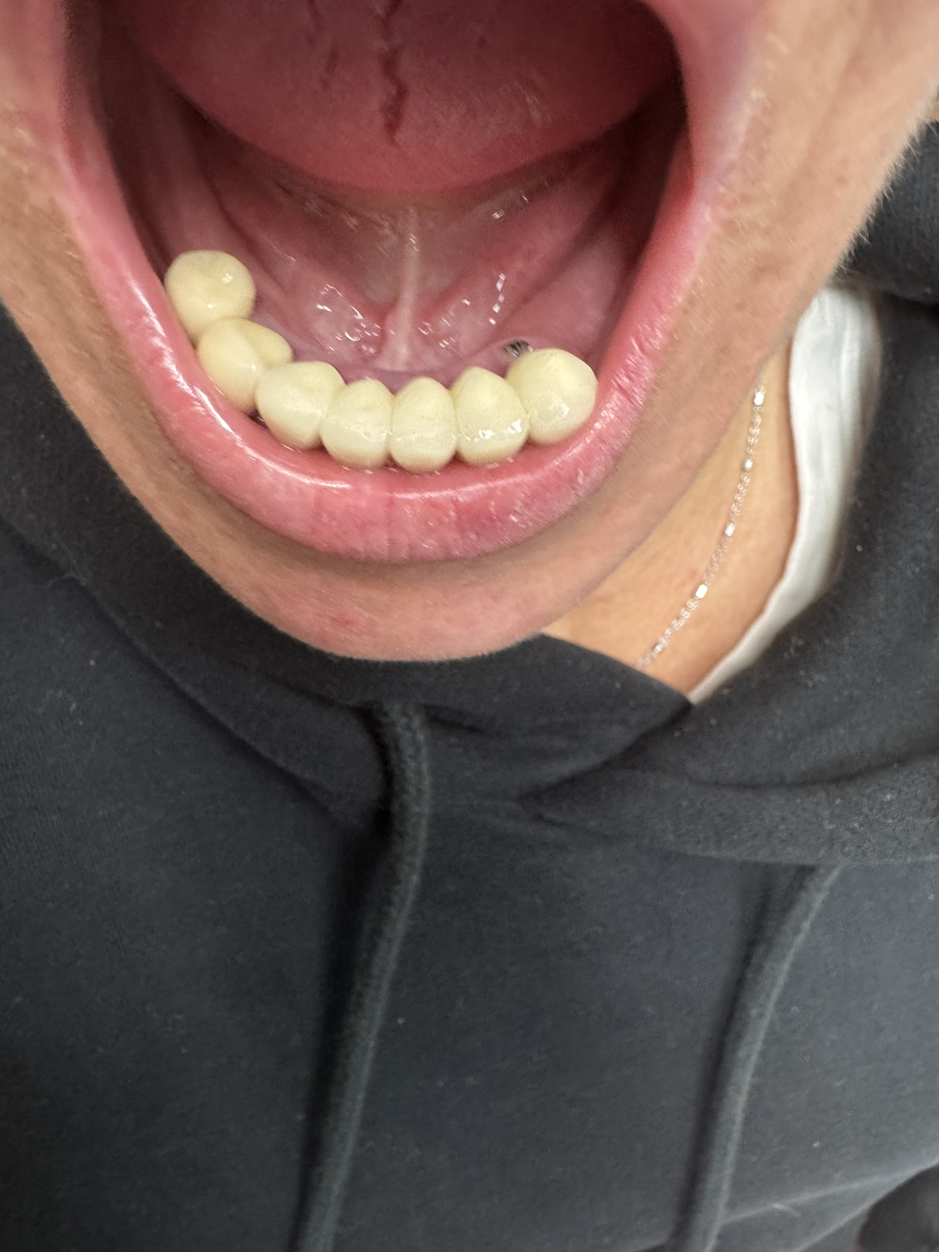 Robotic case before 4