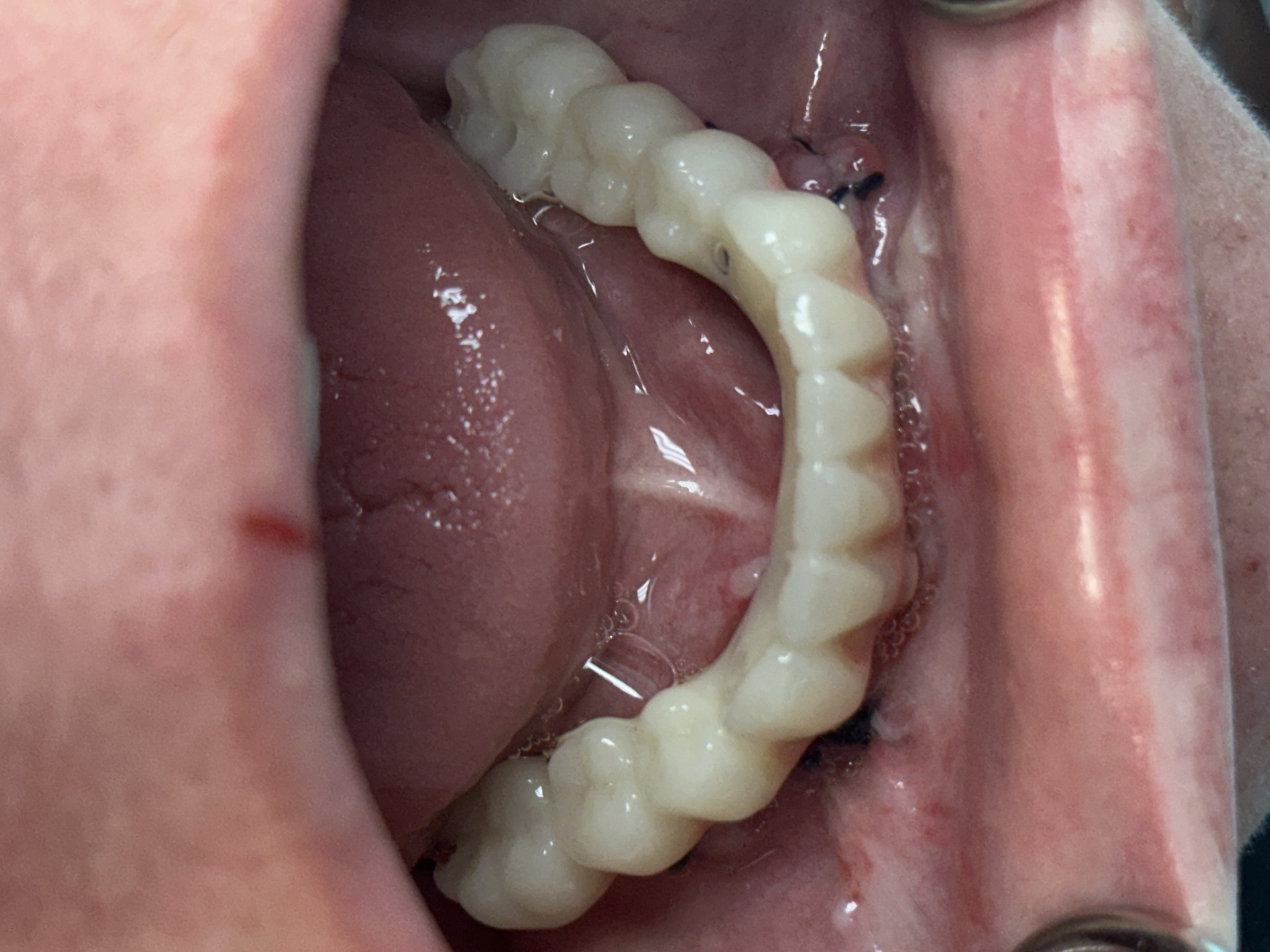 Robotic case after 4