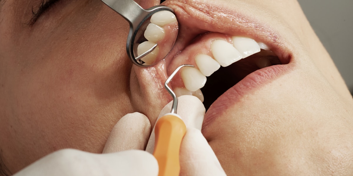 Close-up of a confident smile after full mouth dental implant restoration