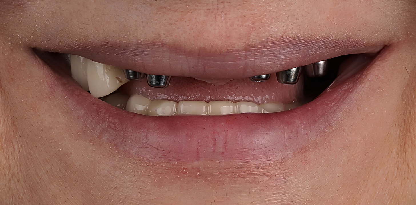 Before