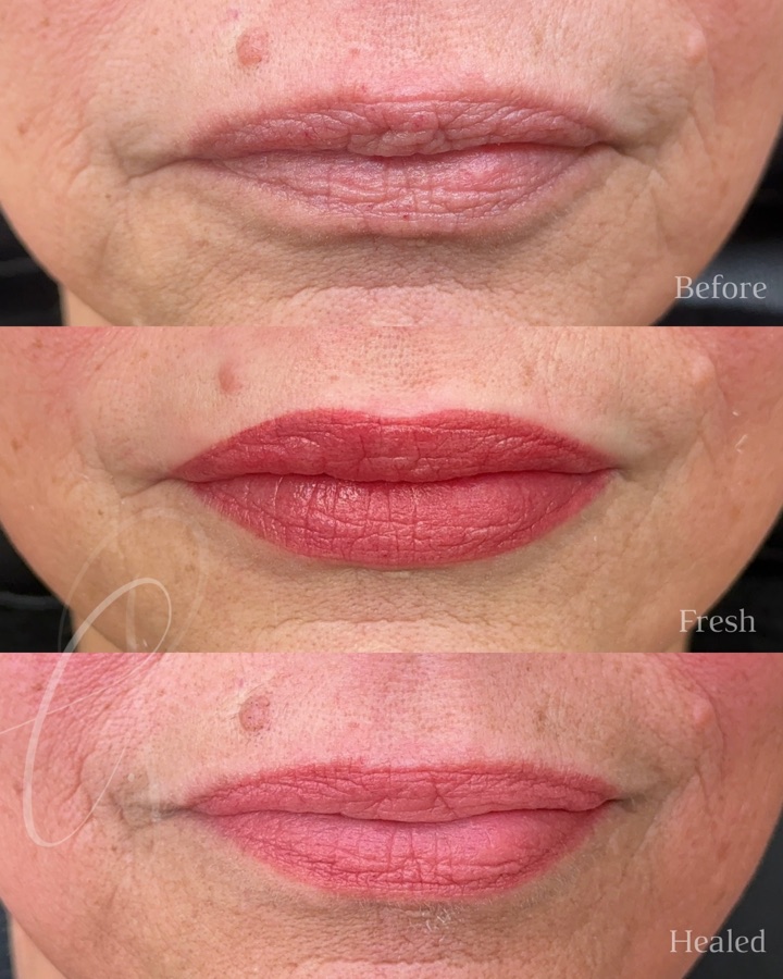 Mature Sculpted Lips before, fresh and healed result
