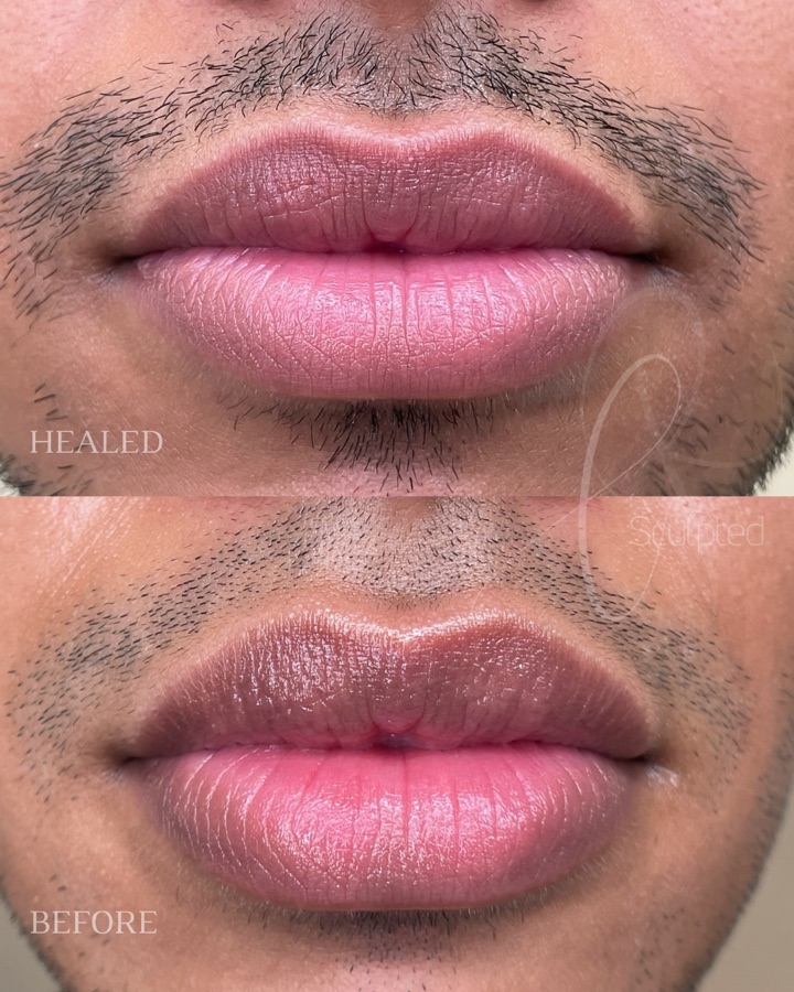 Masculine Sculpted Lips healed result