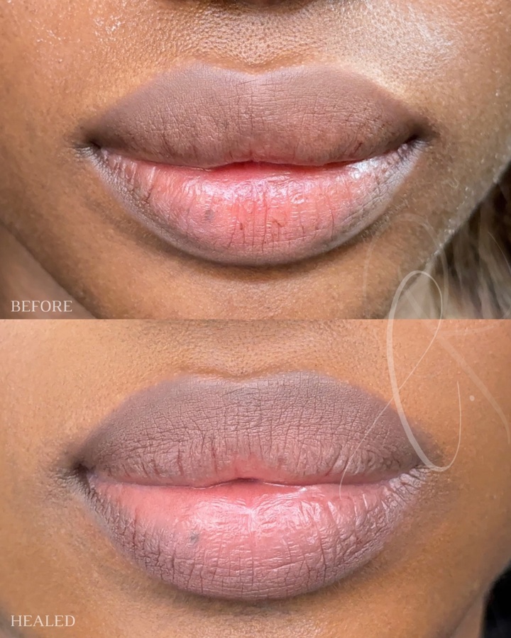 Soft healed Sculpted Lips result