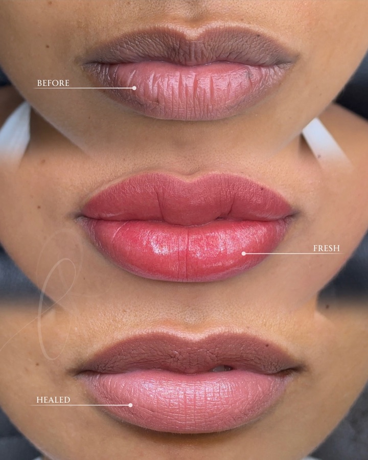 Sculpted Lips before, fresh and healed result