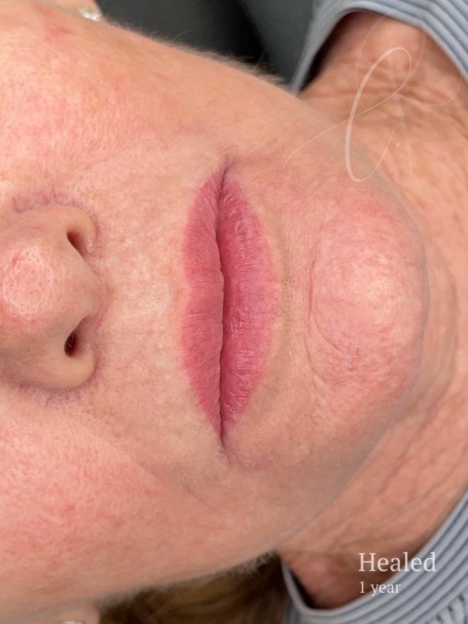 Mature Sculpted Lips before and after result
