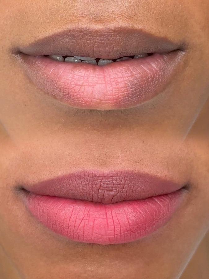 Soft Sculpted Lips before and after result