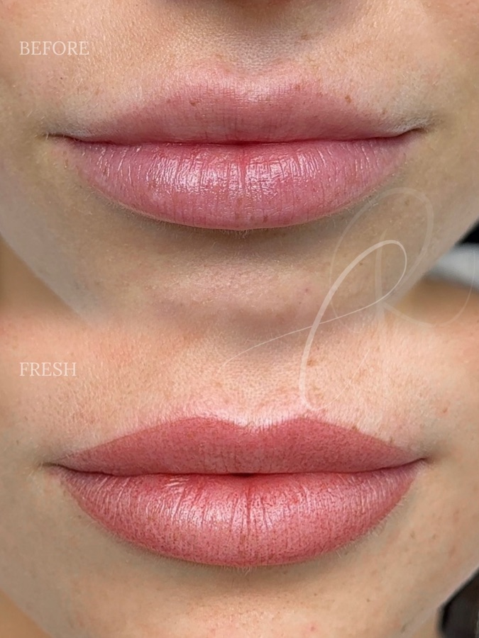 Soft healed Sculpted Lips result