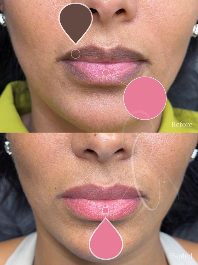 Sculpted Lips client result