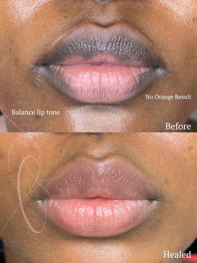 Sculpted Lips before and after result