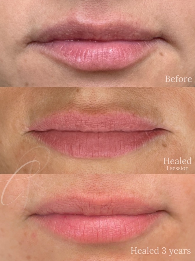 Sculpted Lips before, fresh and healed result