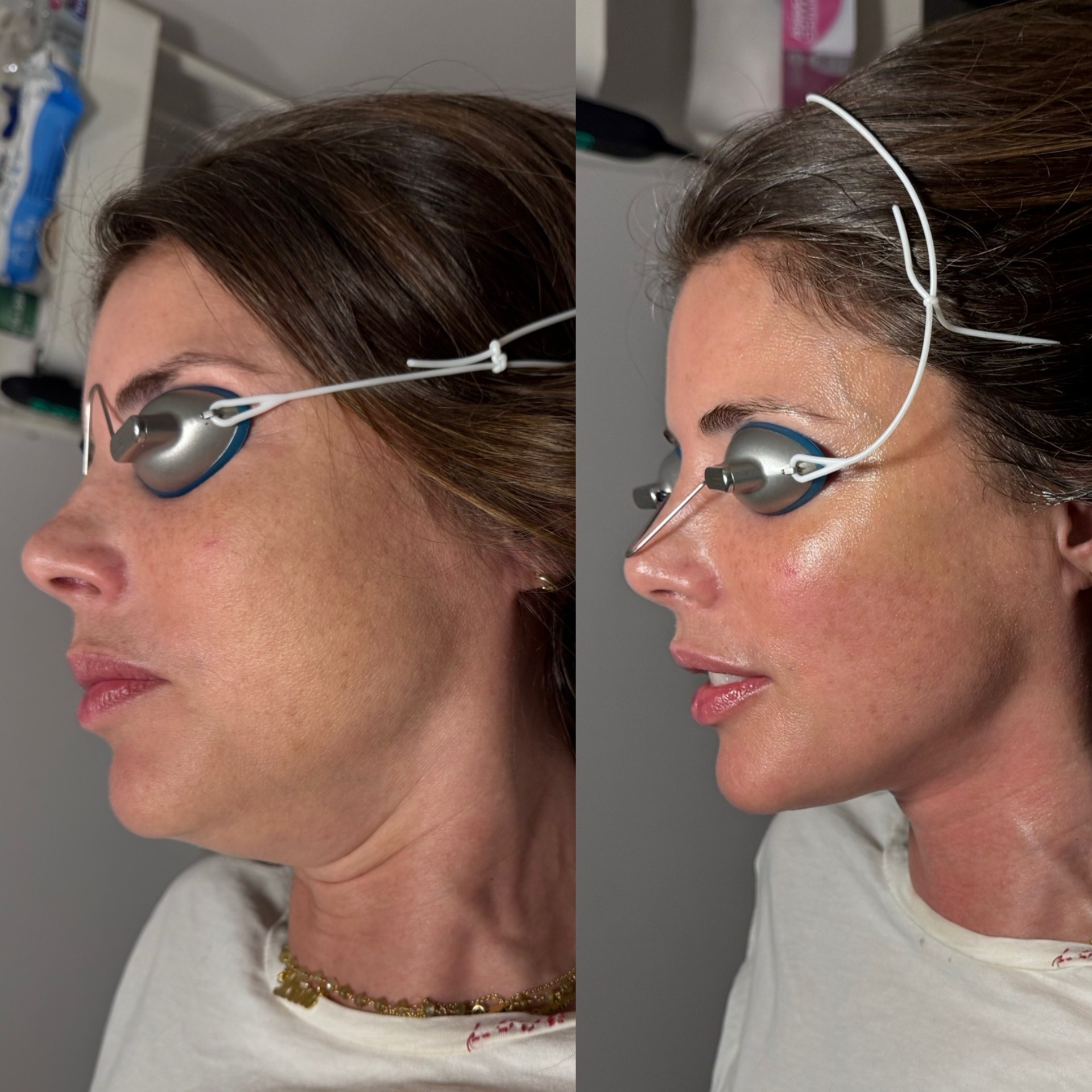Before and After 1
