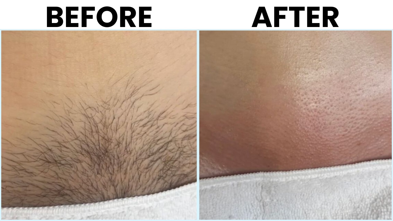 Bikini before and after laser hair removal
