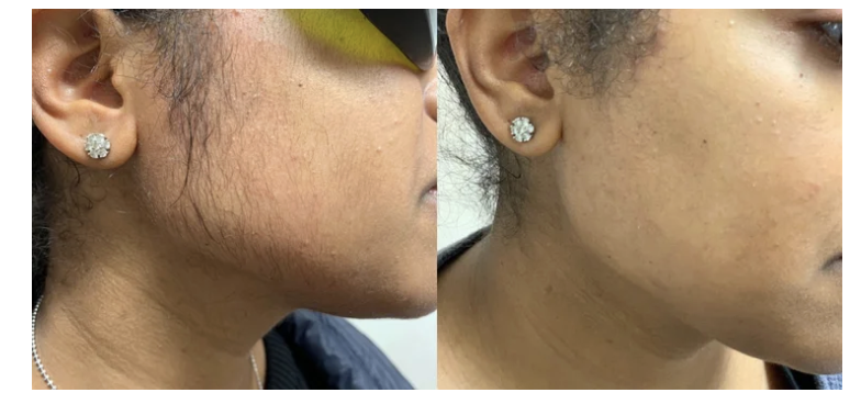 Cheeks and neck before and after laser hair removal