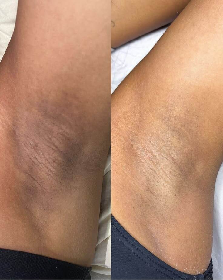 Underarm before and after laser hair removal