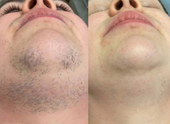 Chin and lip before and after laser hair removal