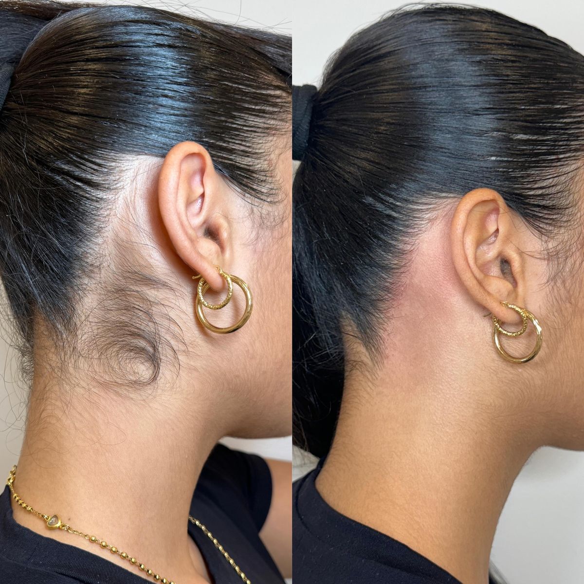 Sideburns before and after laser hair removal