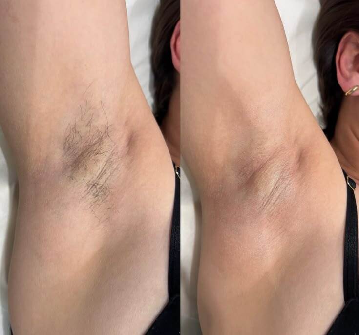 Underarm before and after laser hair removal