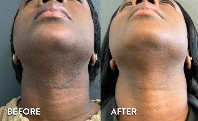 Neck and jawline before and after laser hair removal