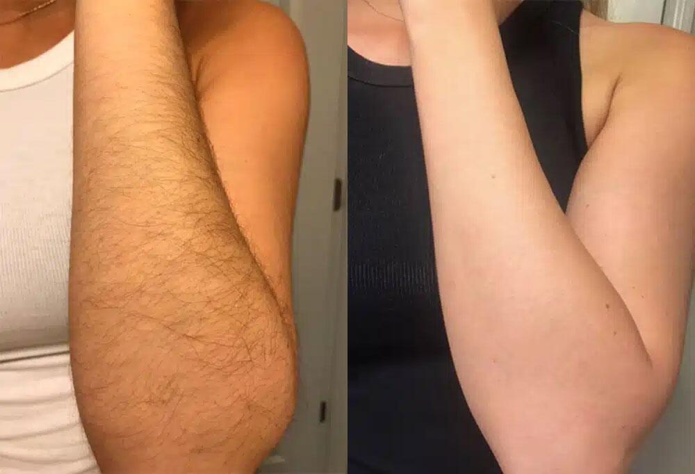 Arm before and after laser hair removal