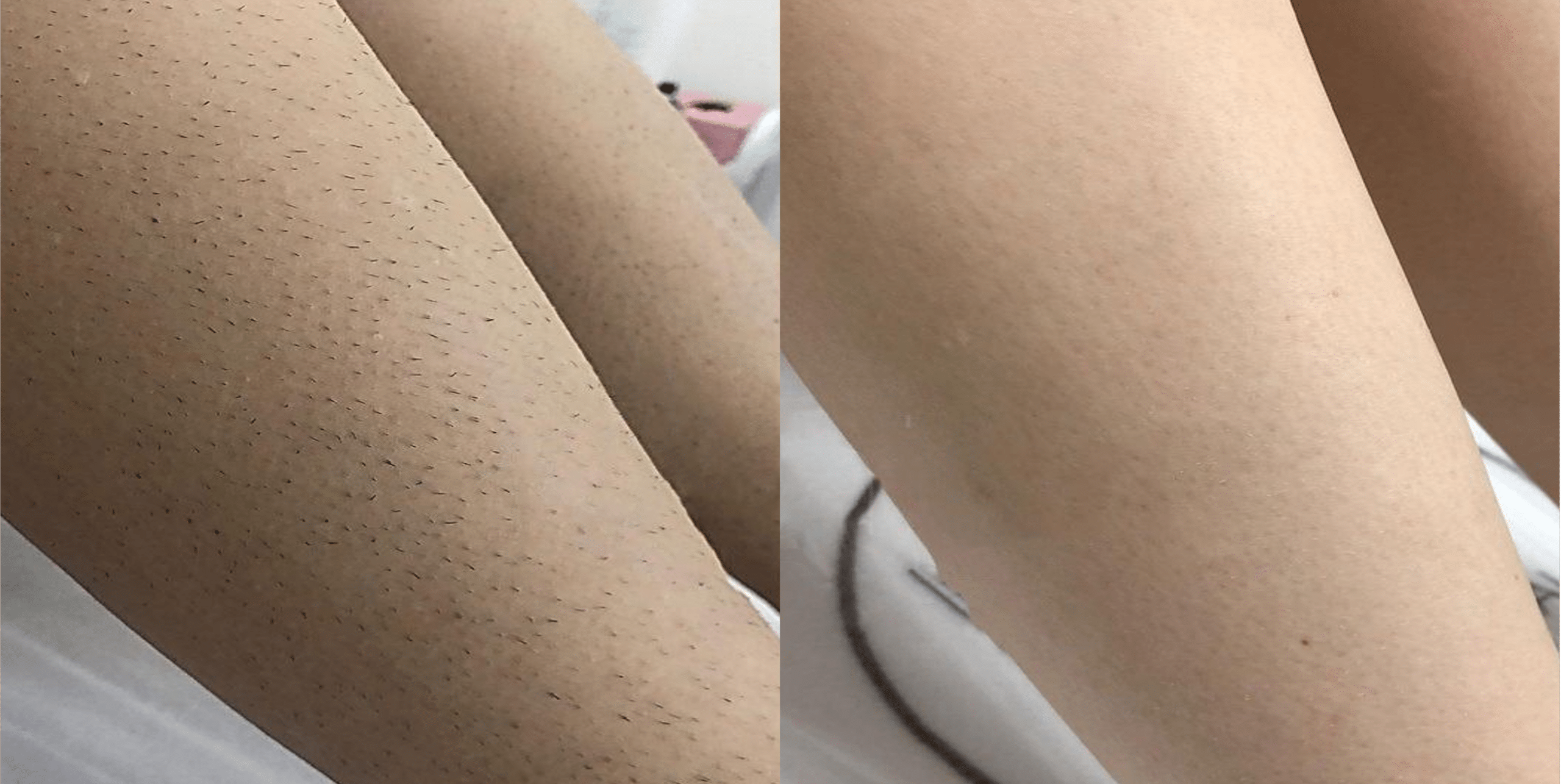Legs before and after laser hair removal