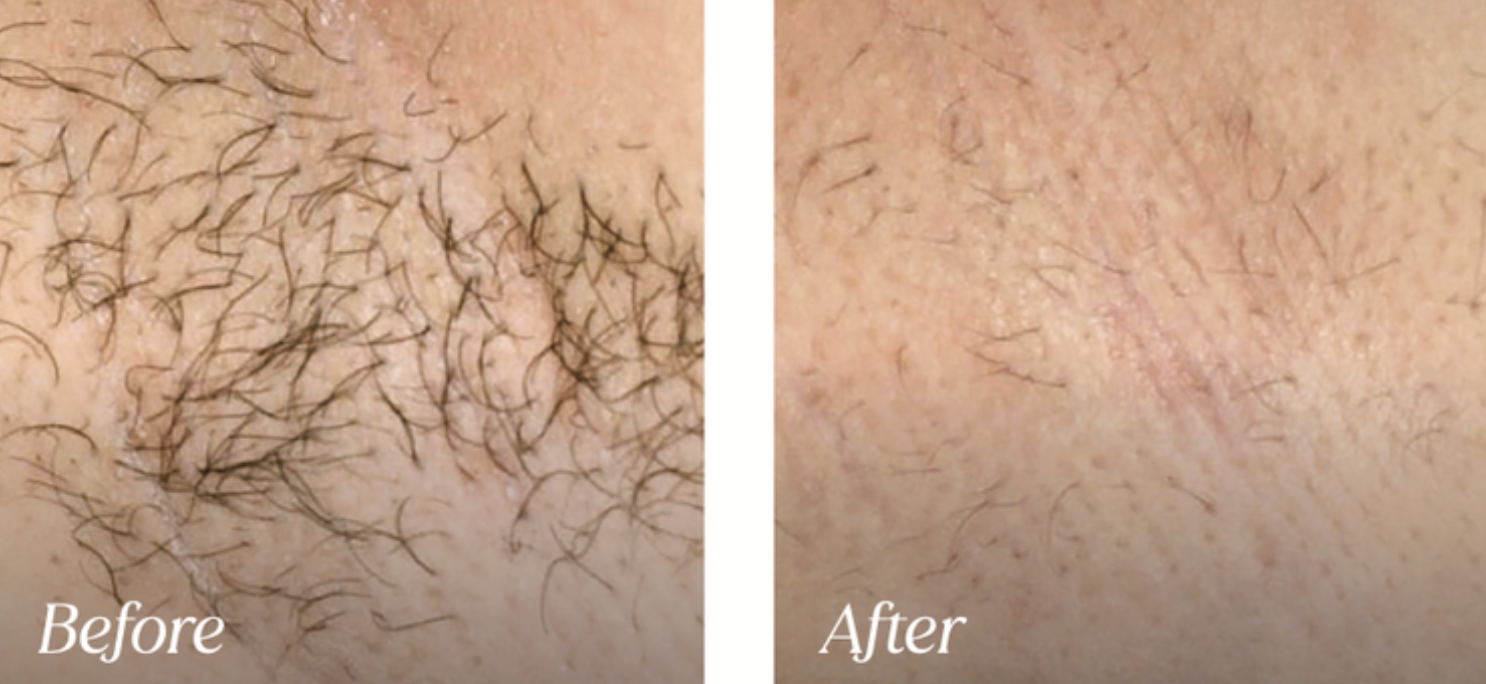 Bikini line before and after laser hair removal