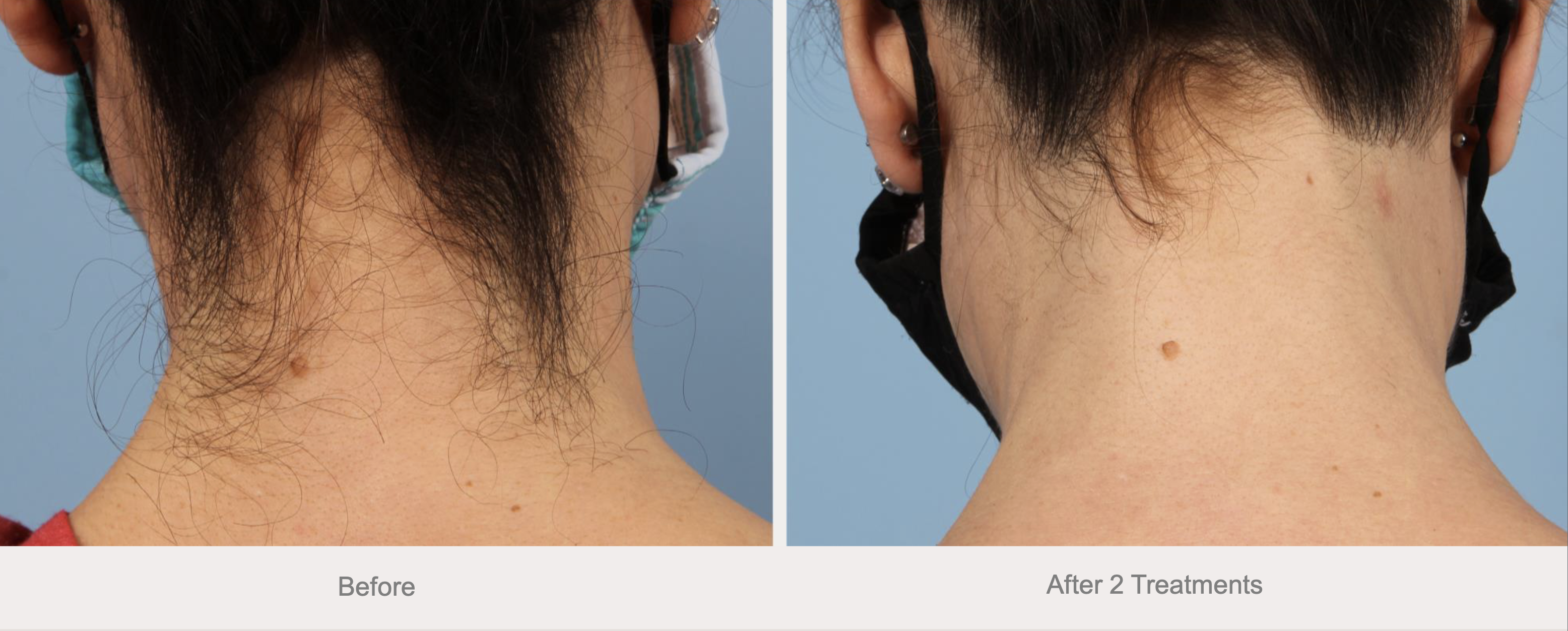 Back of neck before and after laser hair removal