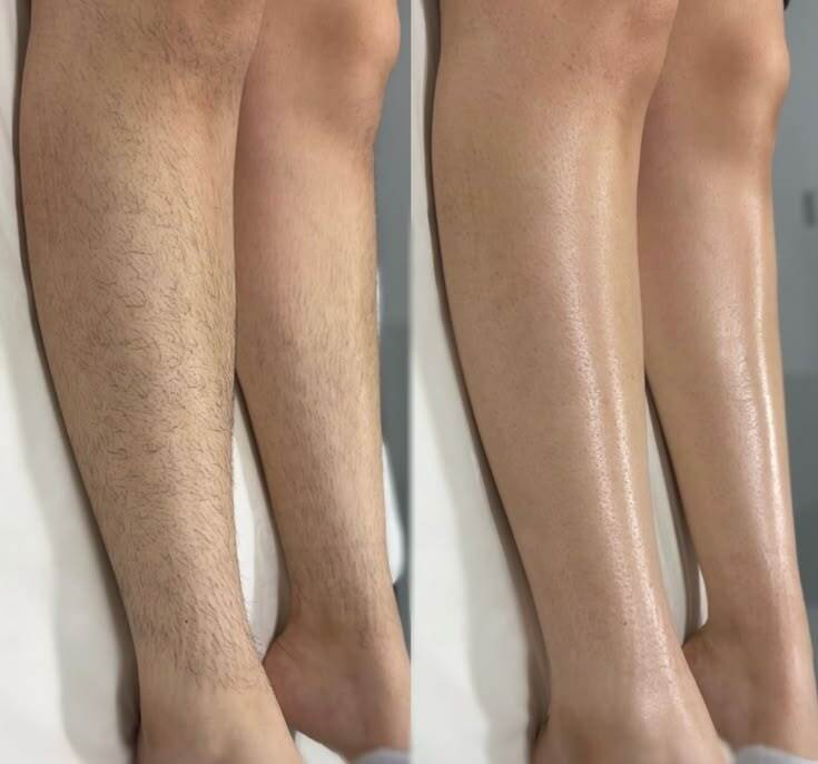 Legs before and after laser hair removal