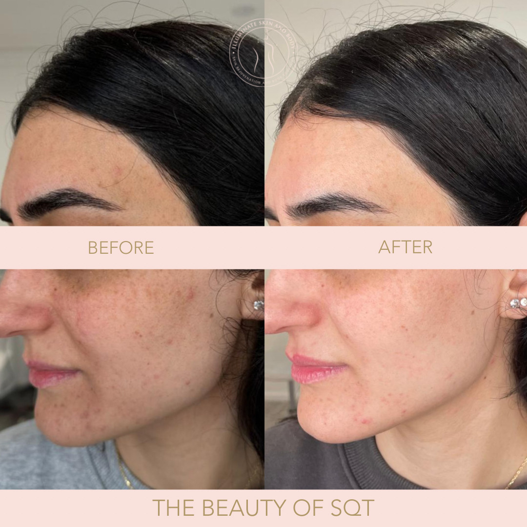 Client skin result before and after treatment at Illuminate Skin and Body