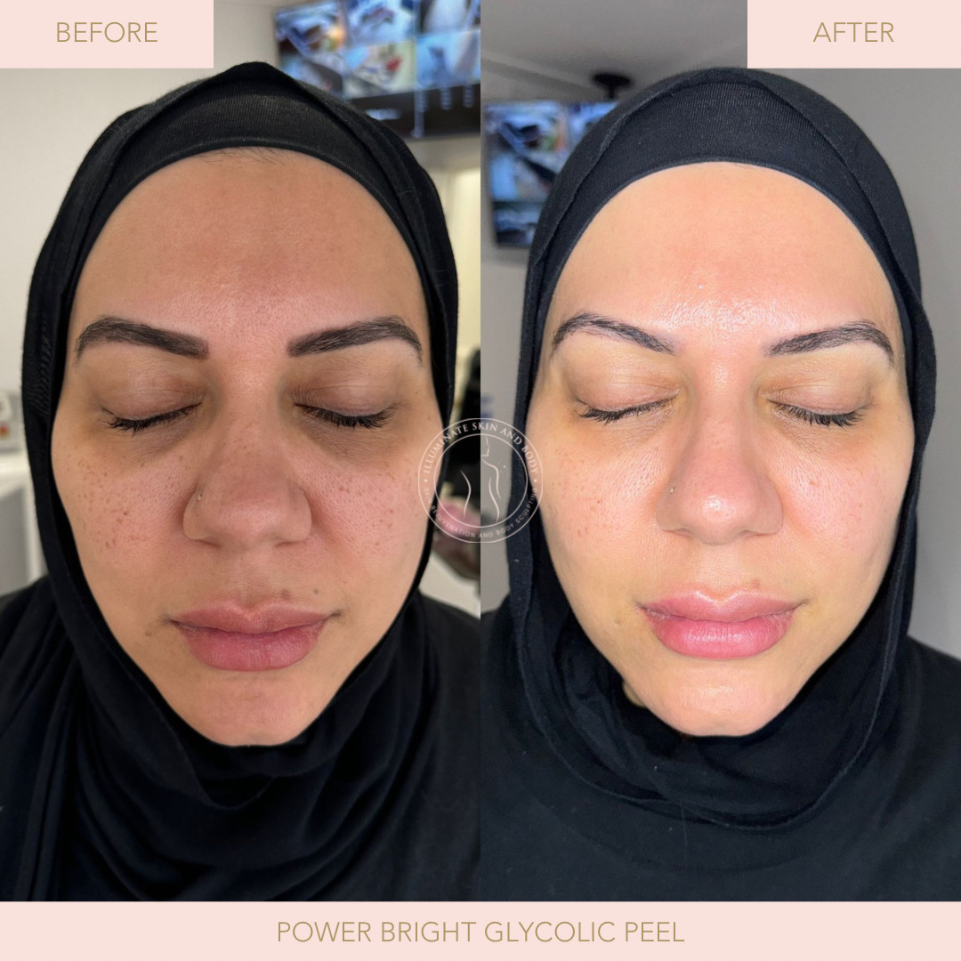 Client skin result before and after treatment at Illuminate Skin and Body