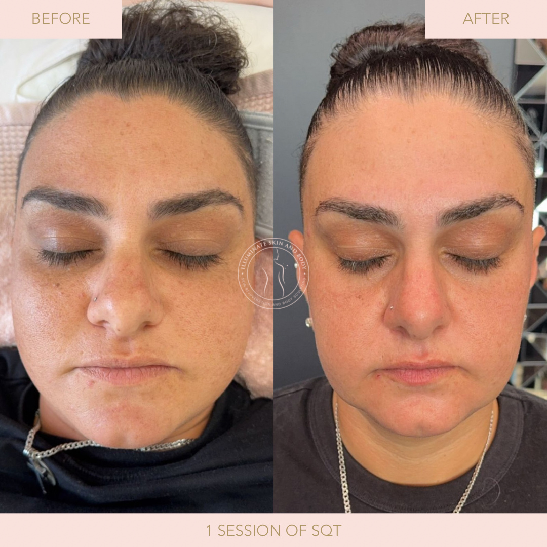 Client skin result before and after treatment at Illuminate Skin and Body