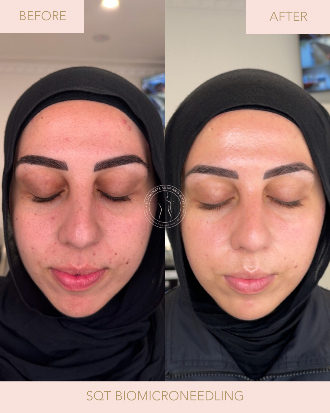 Client skin result before and after treatment at Illuminate Skin and Body