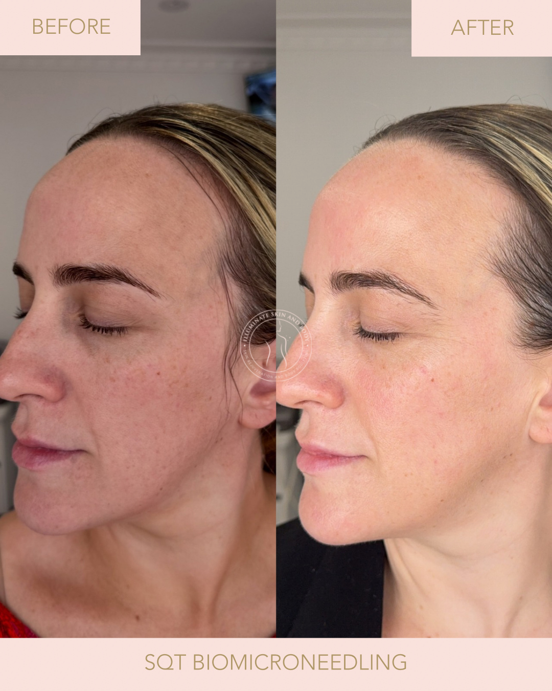 Client skin result before and after treatment at Illuminate Skin and Body
