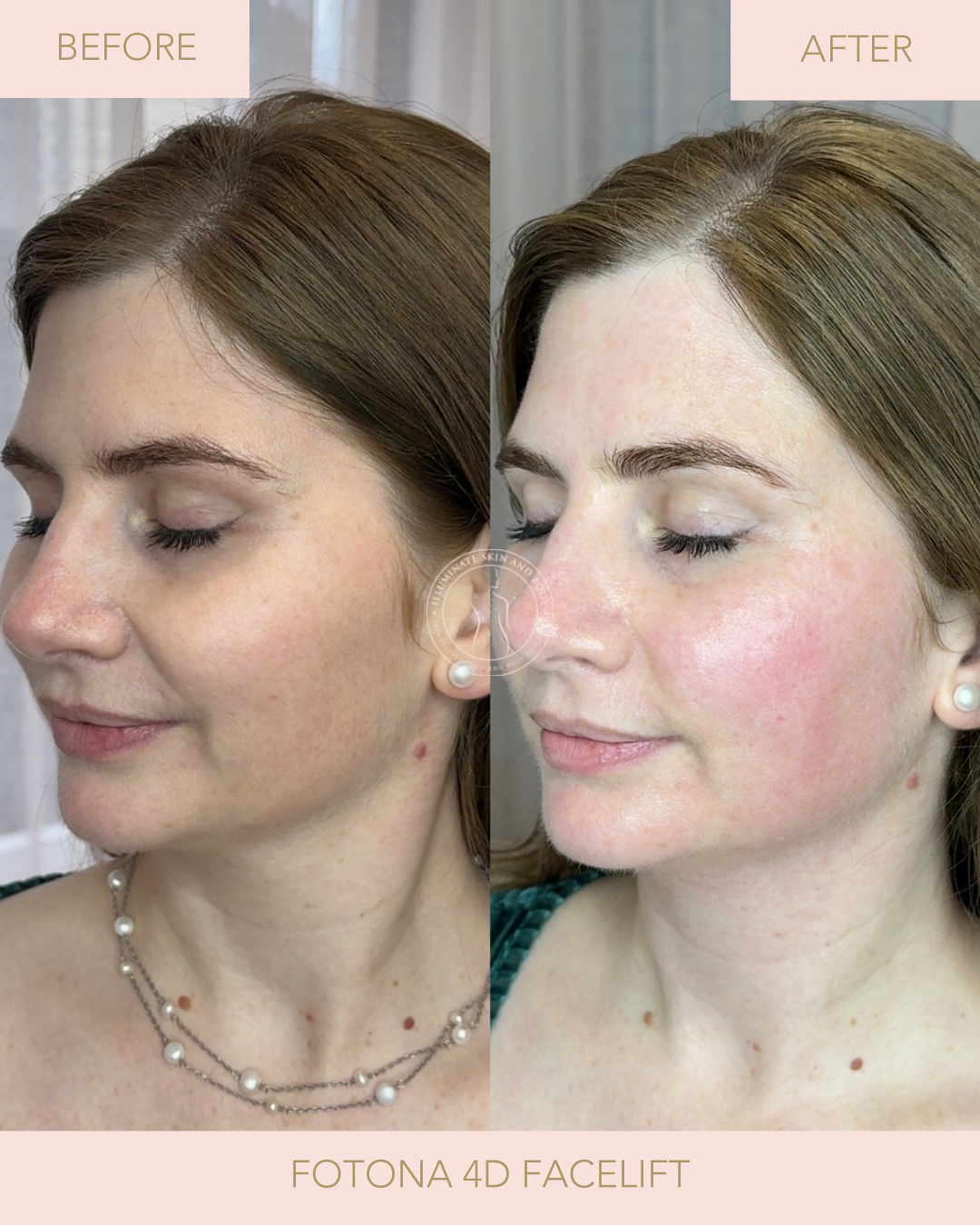 Client skin result before and after treatment at Illuminate Skin and Body