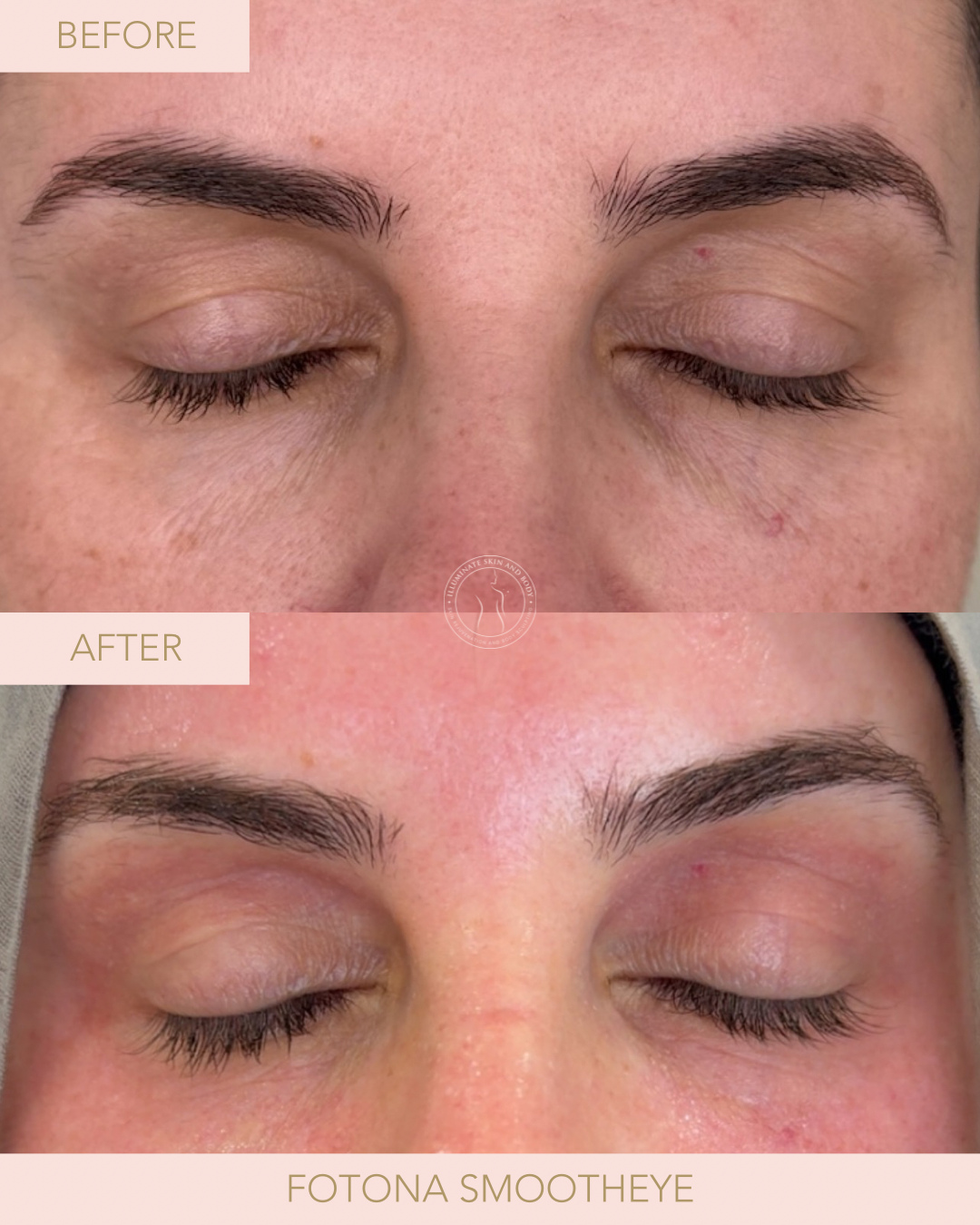 Client skin result before and after treatment at Illuminate Skin and Body