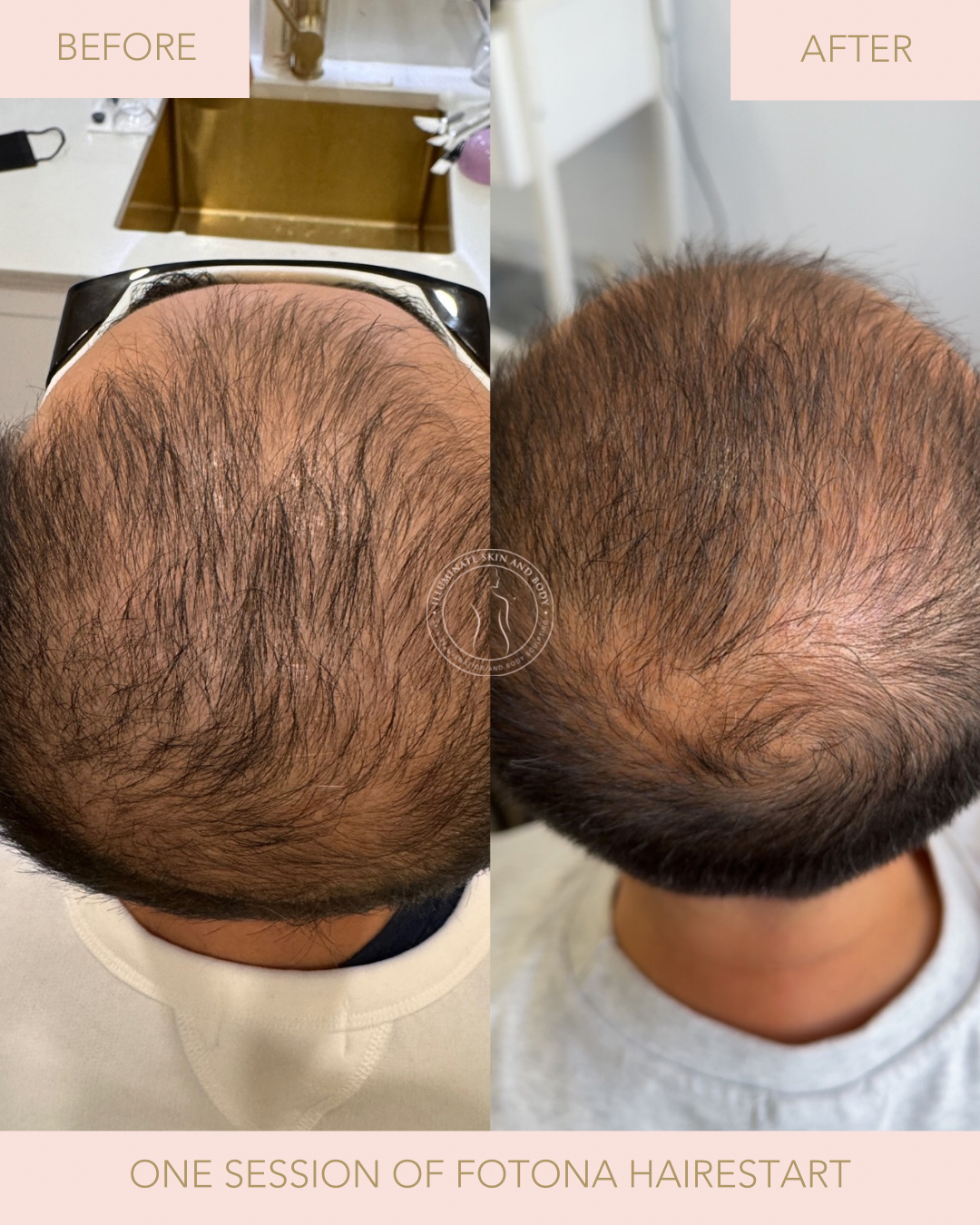 Client skin result before and after treatment at Illuminate Skin and Body