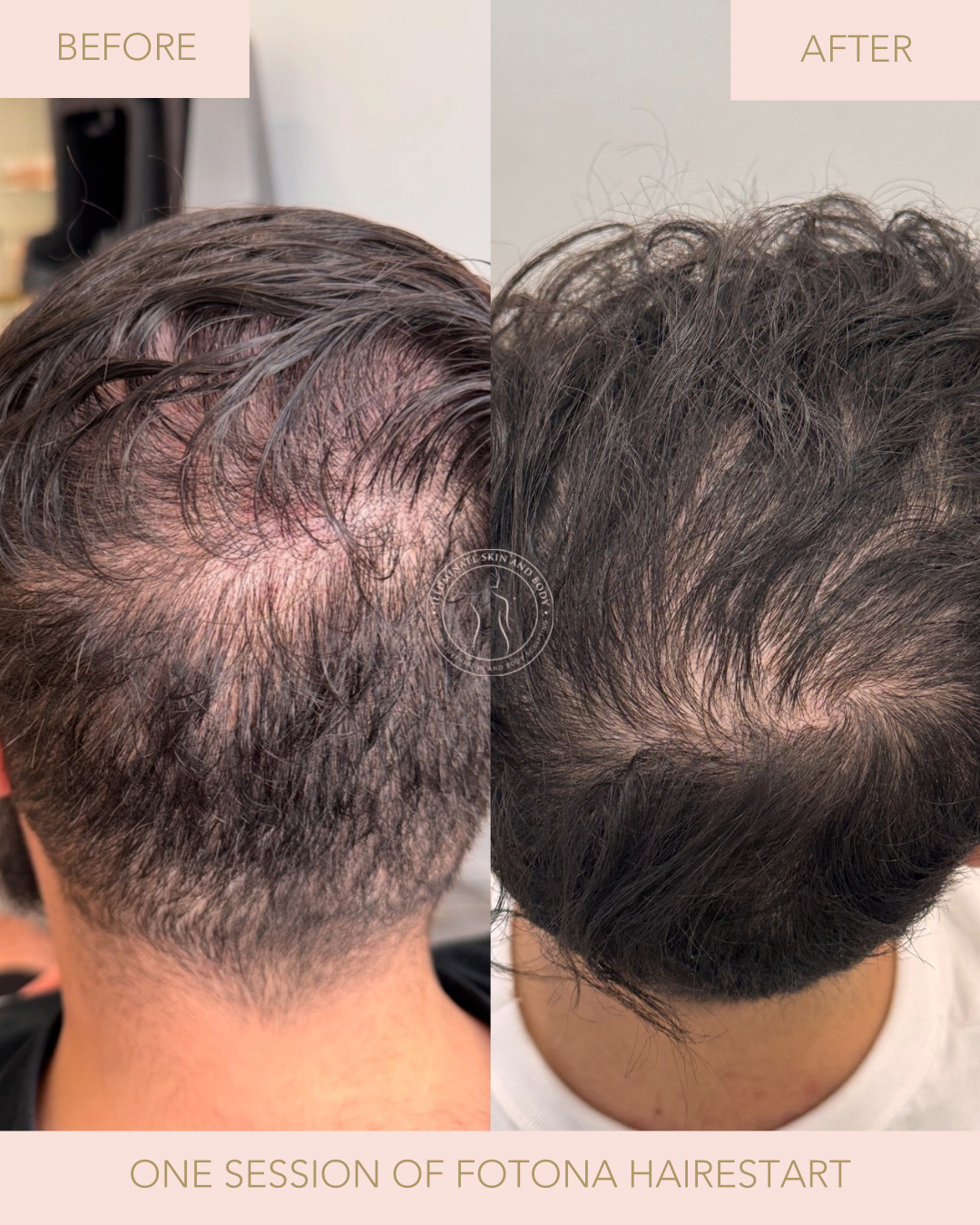 Client skin result before and after treatment at Illuminate Skin and Body