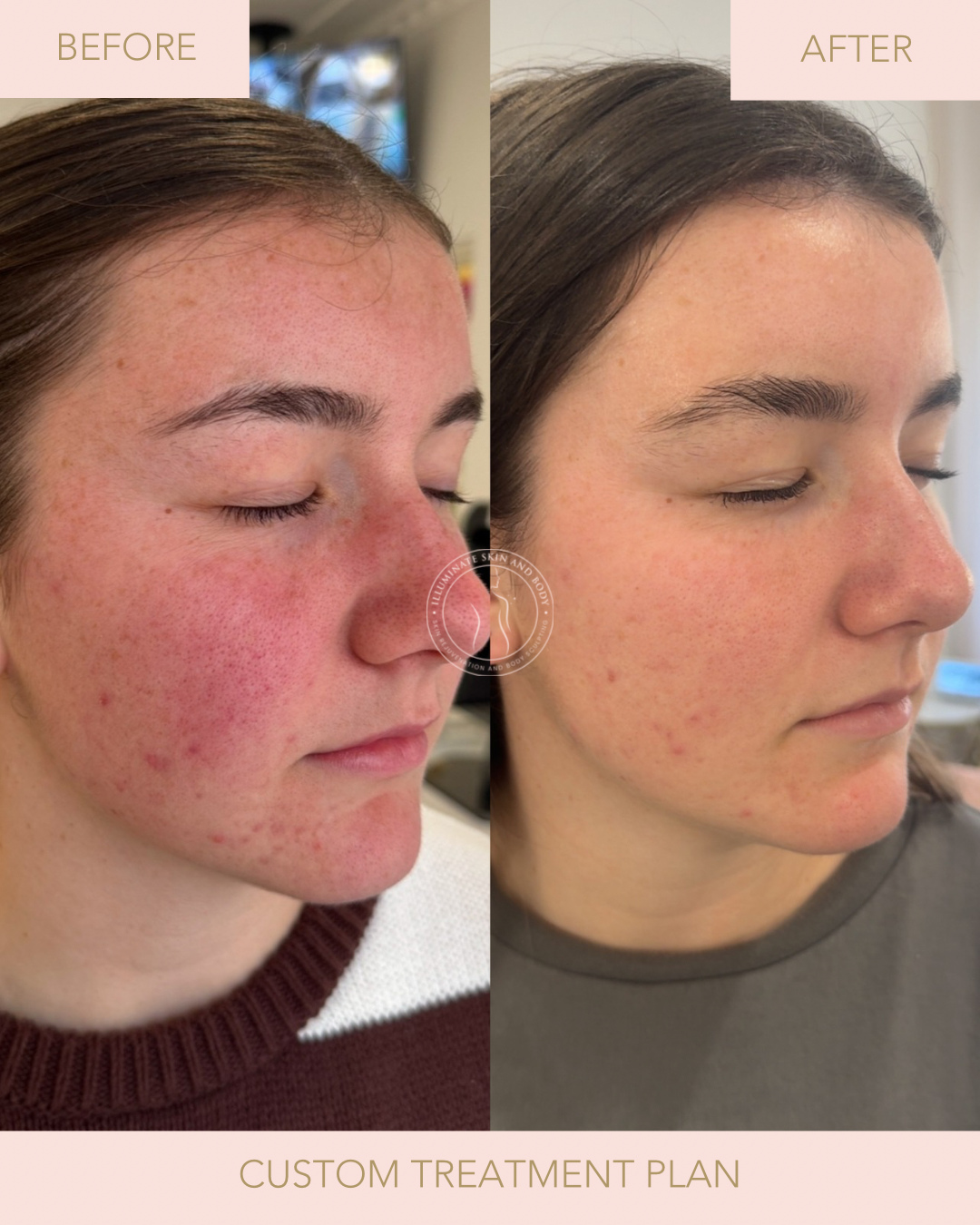 Client skin result before and after treatment at Illuminate Skin and Body