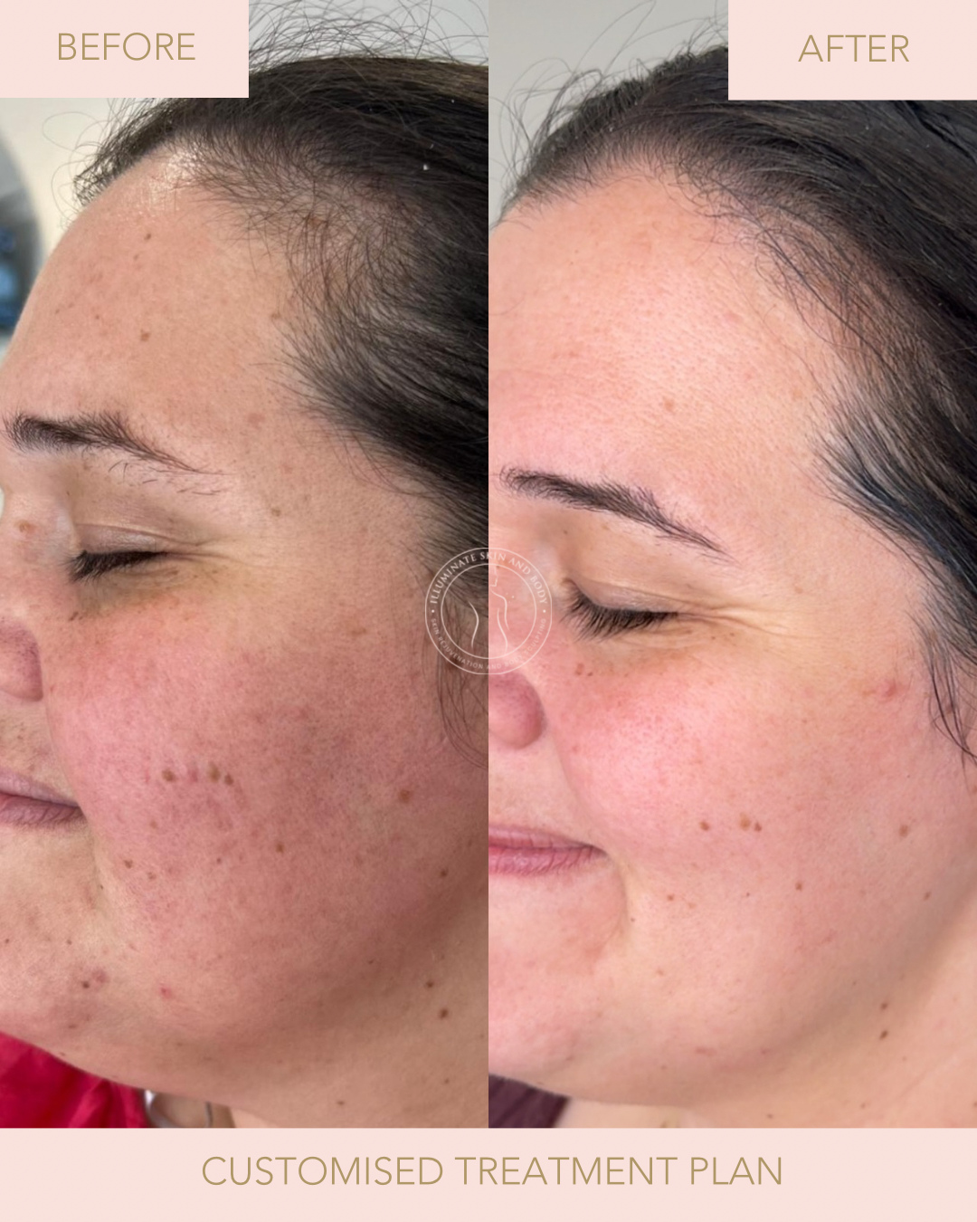 Client skin result before and after treatment at Illuminate Skin and Body