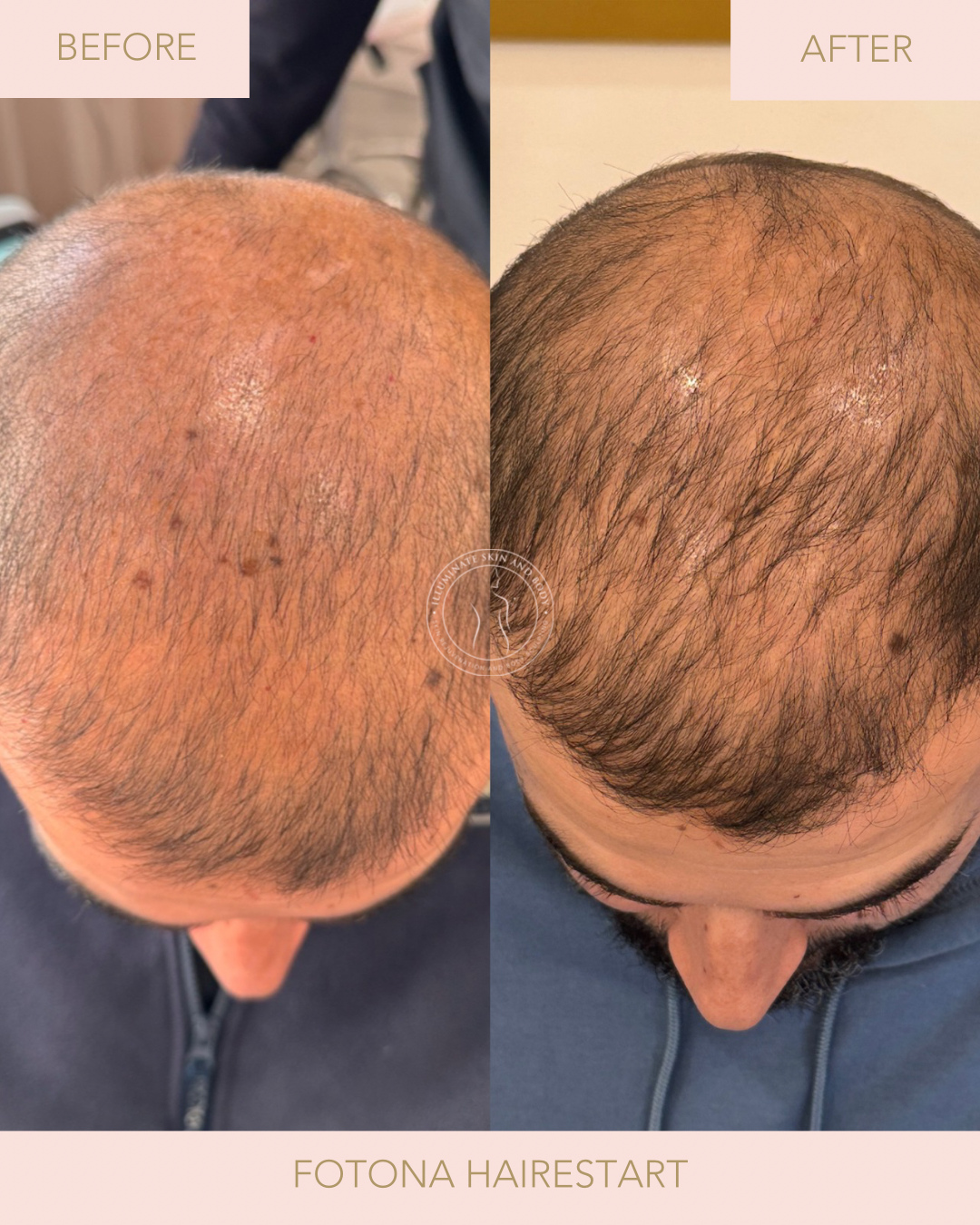 Client skin result before and after treatment at Illuminate Skin and Body