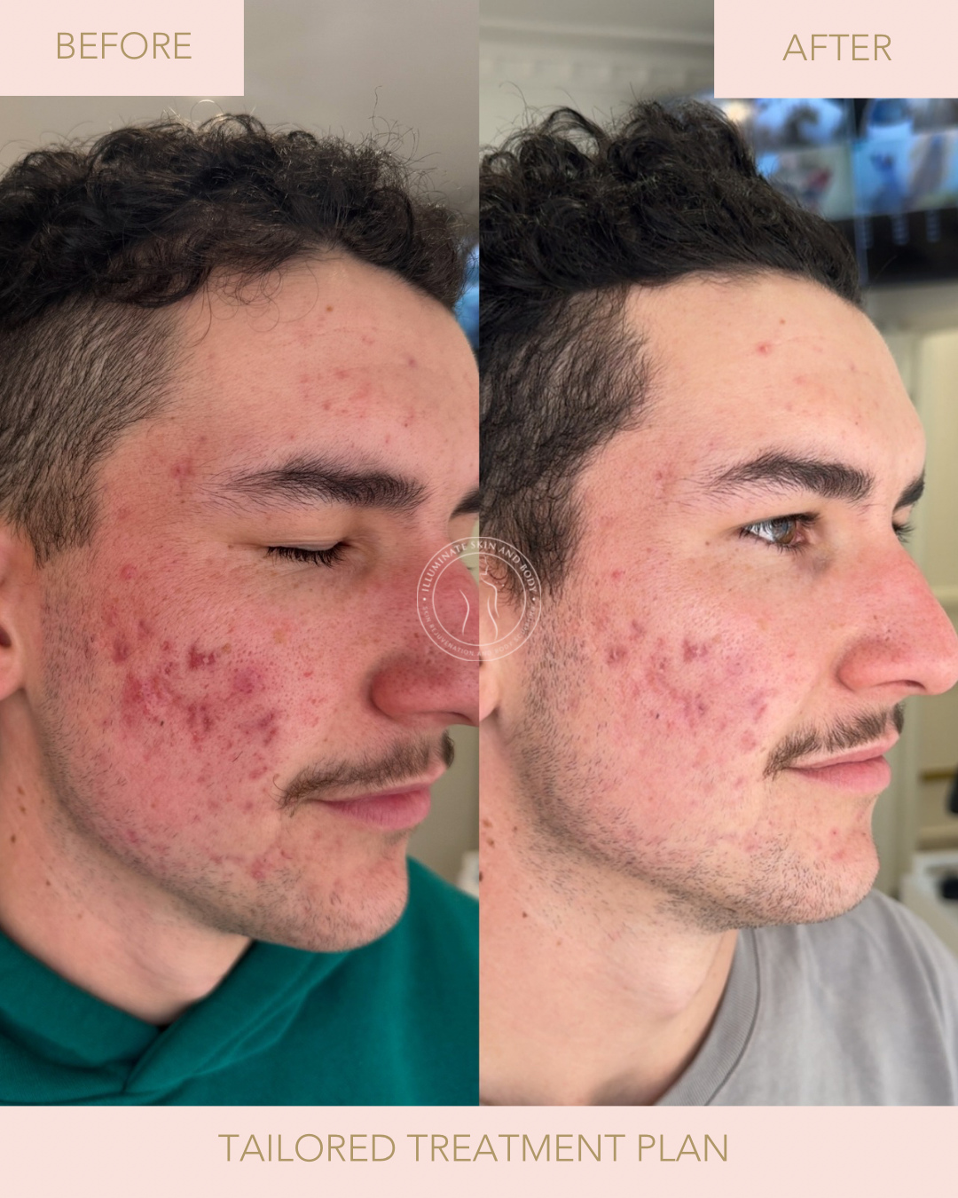 Client skin result before and after treatment at Illuminate Skin and Body