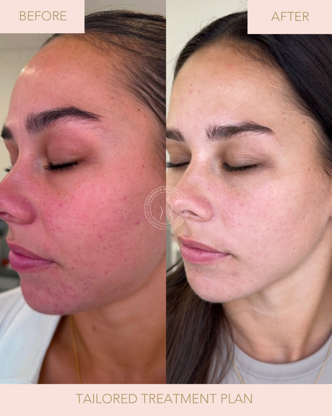 Client skin result before and after treatment at Illuminate Skin and Body